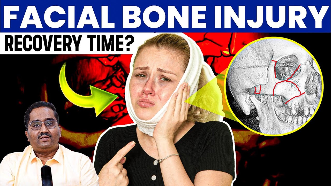 What is Expected Recovery Time after Facial Bone Injury?