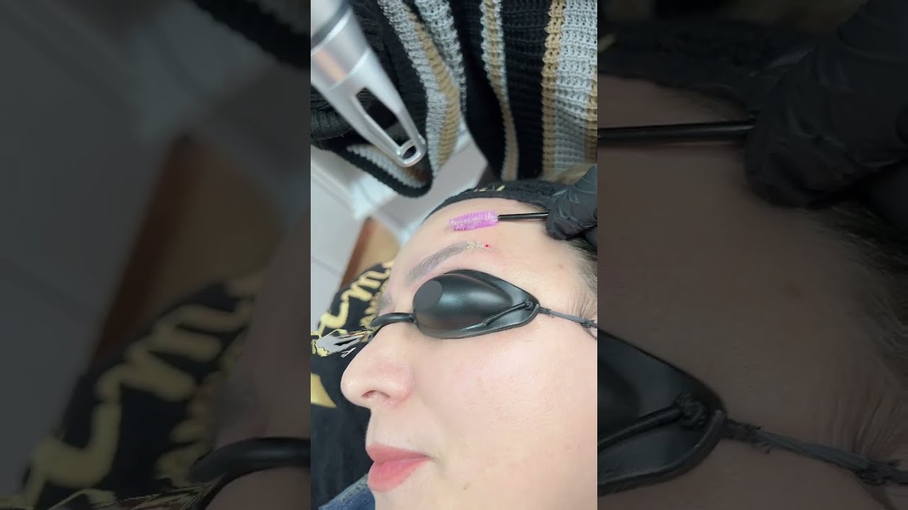 Kalıcı Kaş Silme | Pico Lazer ile Kaş Silme İşlemi Hamiyet Güzellik Salonu Balgat Ankara