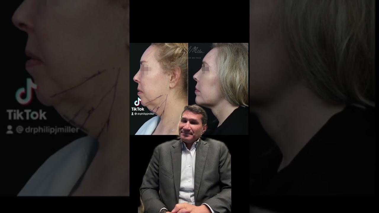 MyEllevate, A New NonSurgical Procedure To Define Your Jawline And Chin！