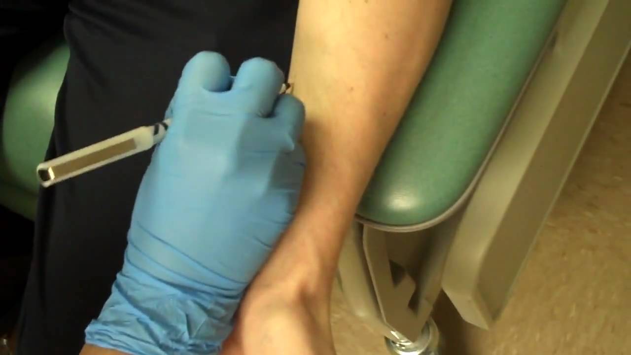 Allergy Testing Step 1, Skin Prick Testing
