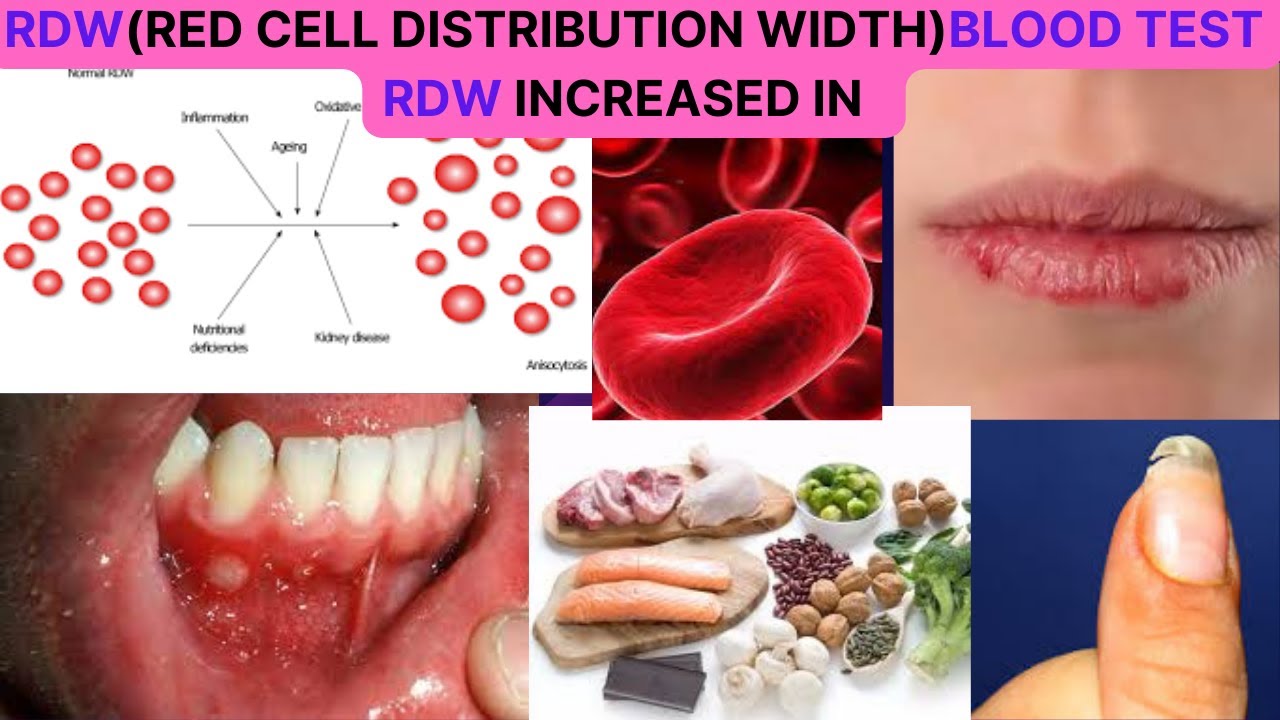 RDW(RED CELL DISTRIBUTION WIDTH) BLOOD TEST NORMAL RANGE CAUSES OF HIGH RDW? HOW TO REDUCE IT?