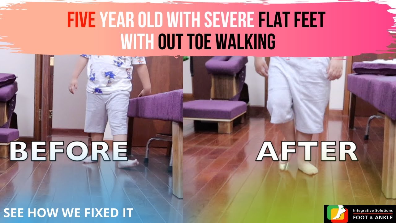 5 Year Old with Severe Flat Foot and Out Toe Walk Pattern | dr lee foot