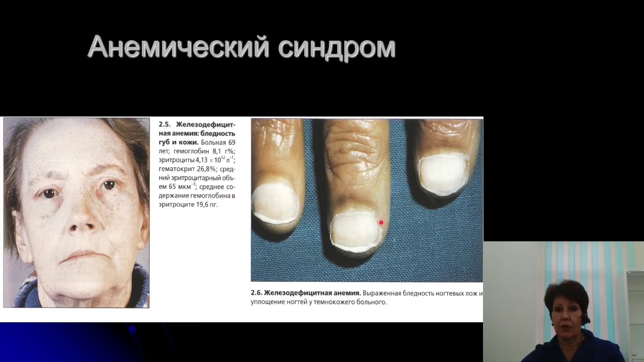Факультетская терапия (Внутренние болезни). Анемии