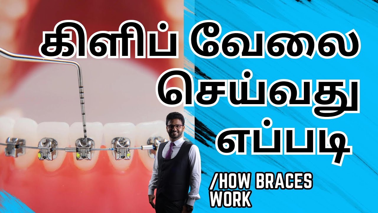 கிளிப் சிகிச்சை வேலை செய்வது எப்படி ?How BRACES WORK in tamil