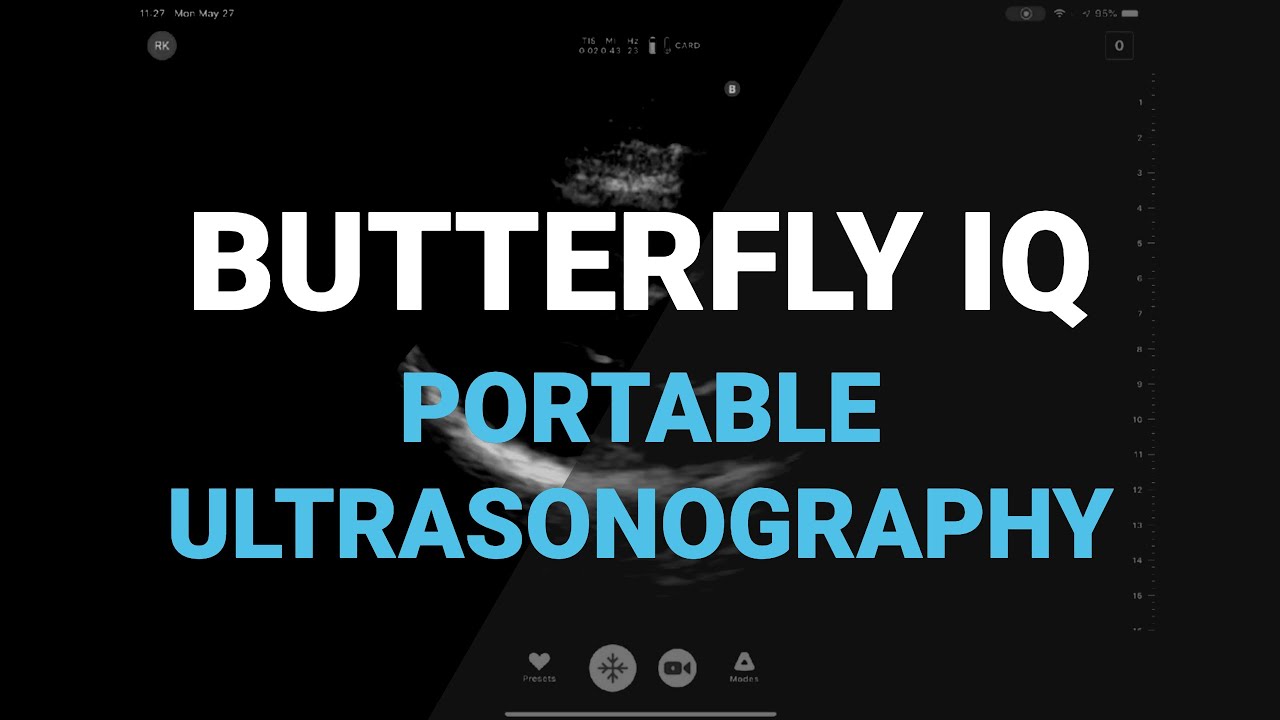 The Butterfly iQ Ultrasound