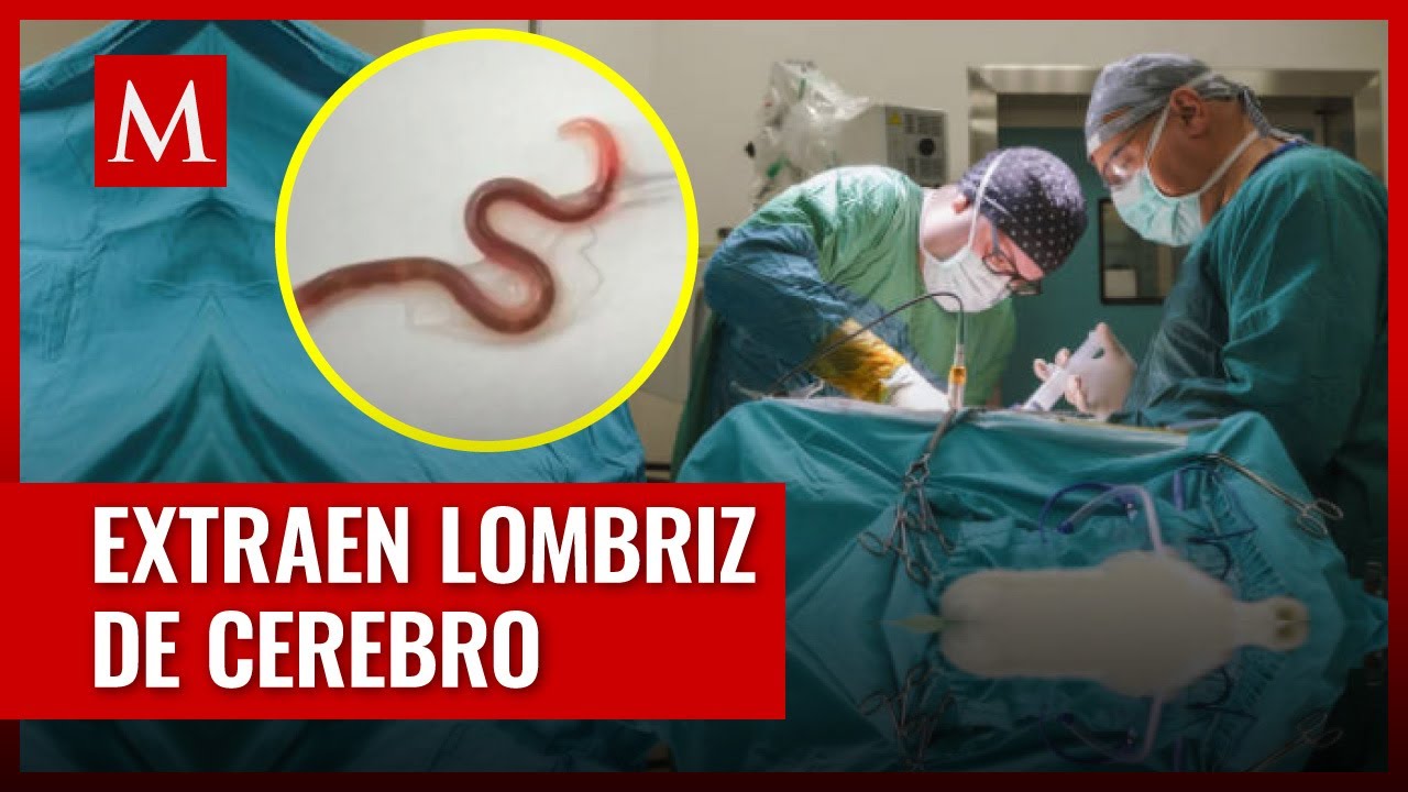 Encuentran lombriz intestinal en cerebro de una mujer australiana