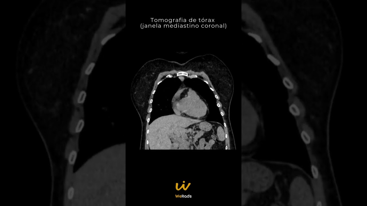 Caso do Dia  - Tórax
