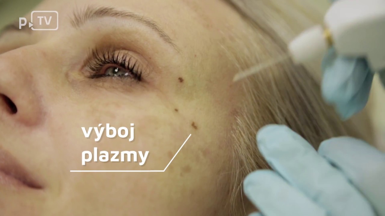 Odstranění pigmentací, znamínek, bradavic a jizev pomocí Plexru