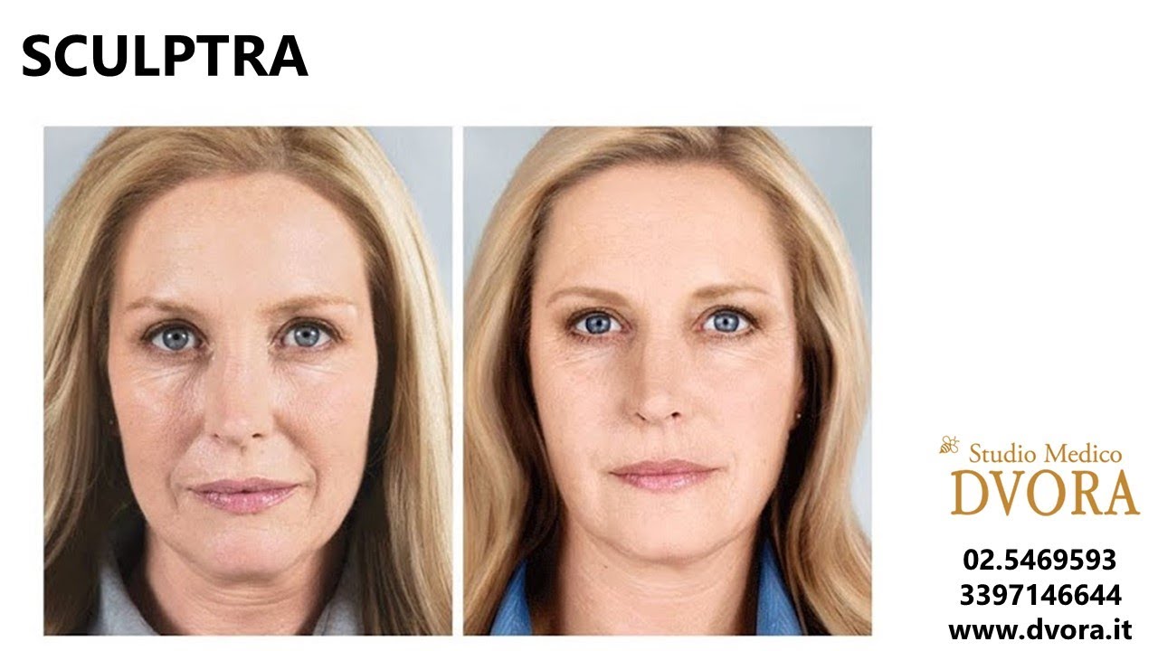 TRATTAMENTO SCULPTRA FILLER VISO: RINGIOVANIMENTO DEL VOLTO SENZA BISTURI