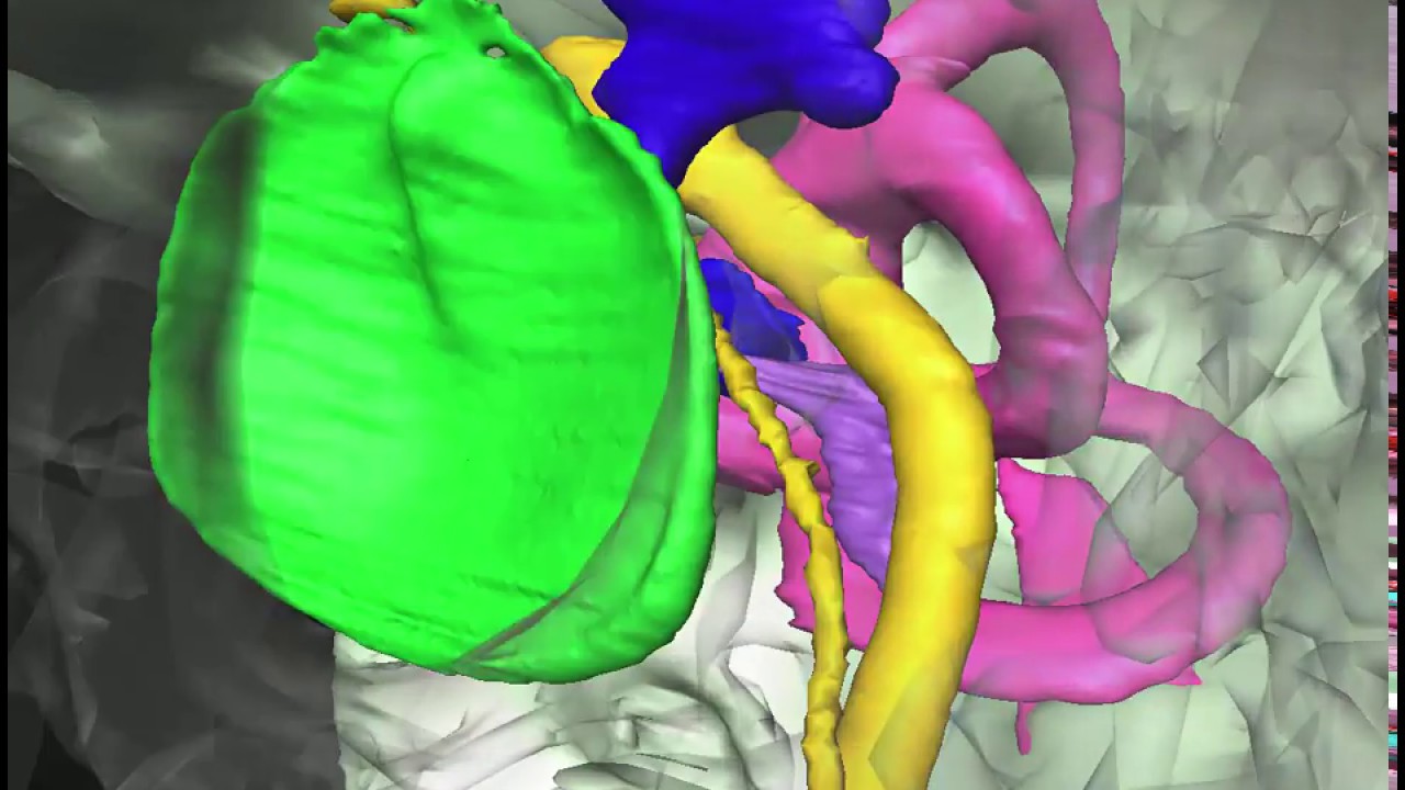 Anatomy of the Facial Nerve in the Temporal Bone with Audio