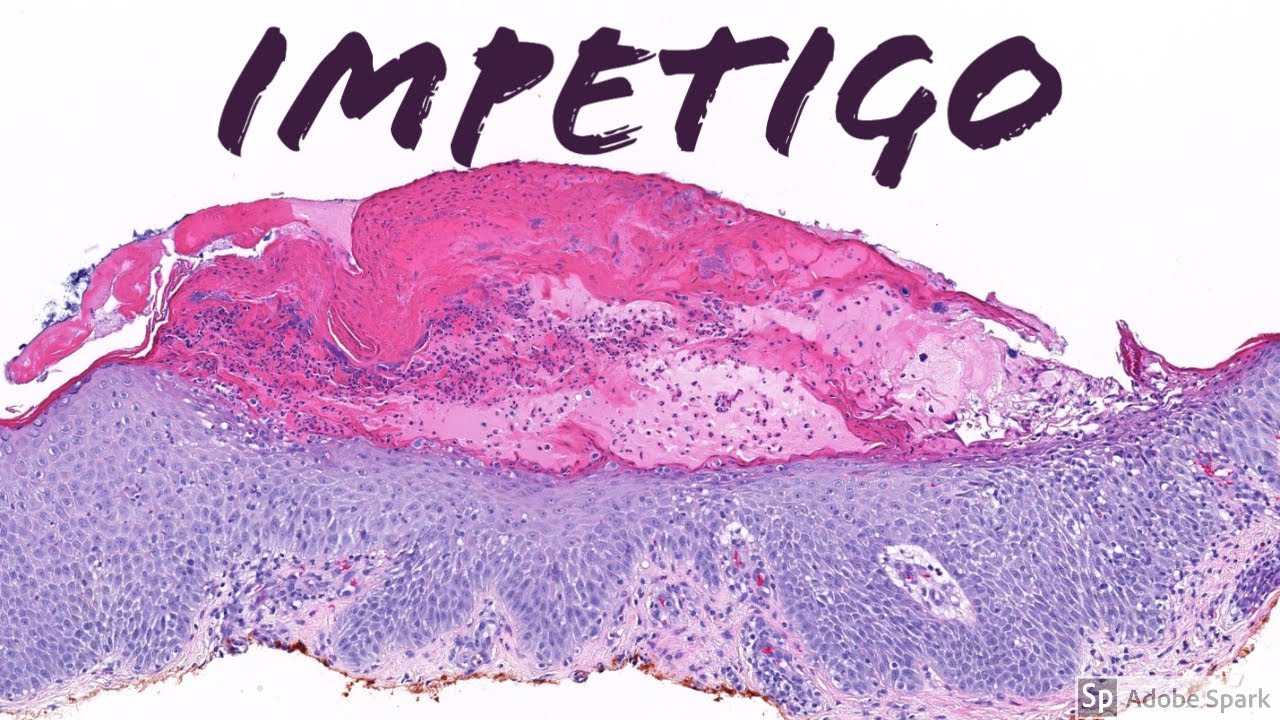 Impetigo: 5-Minute Pathology Pearls