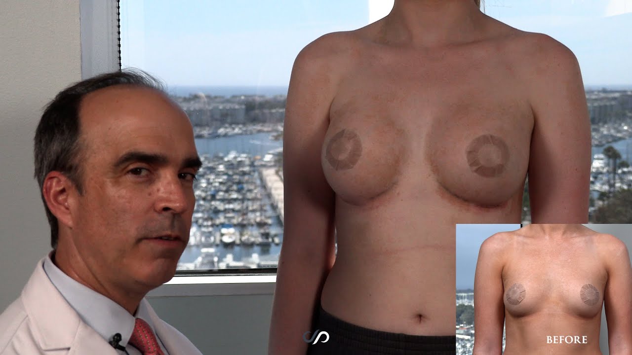 L.A.. Natural Breast Augmentation | 12 Day Post-op | Dr. David Stoker