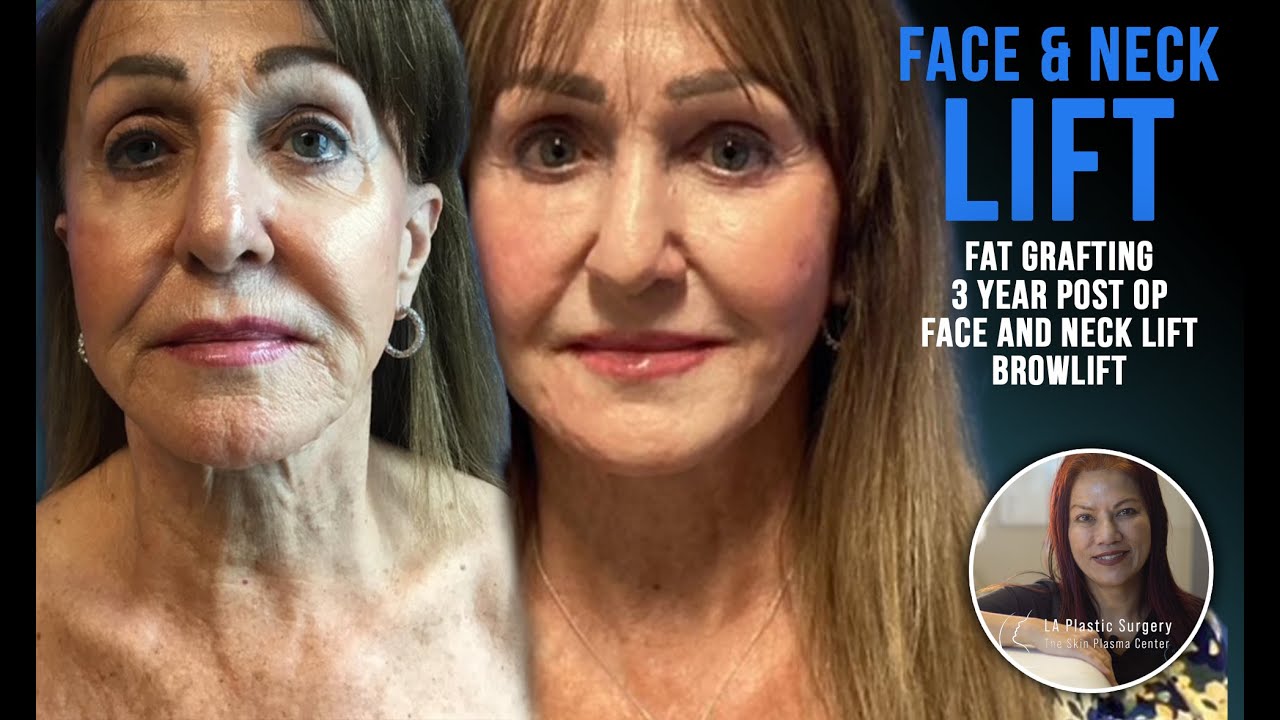 72-Year-Old Facial Rejuvenation | Award-Winning Transformation