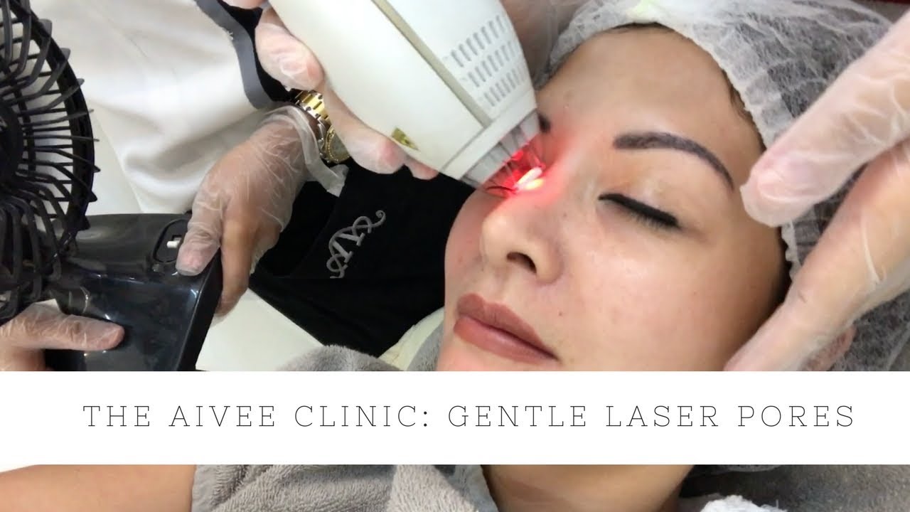 GENTLE LASER PORES AT THE AIVEE CLINIC | Cat Arambulo-Antonio