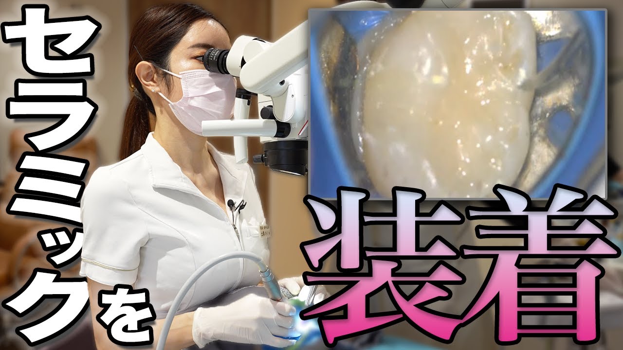 セラミック装着の工程を全て見せます！(セラミックインレー / ラバーダム)