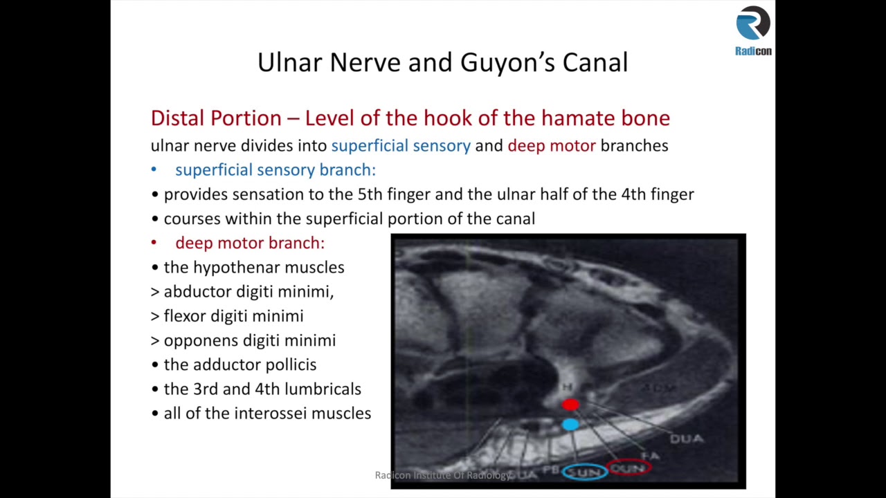 Wrist MRI Part 6: Guyons Canal