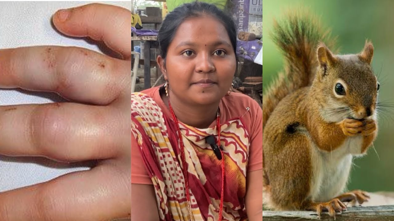 அணில் கடிச்சா இப்படியும் ஆகுமா 
