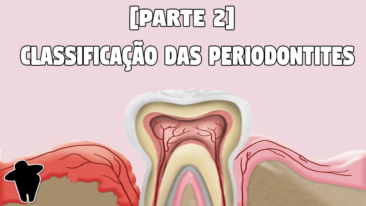 Aula de Classificação das Doenças Periodontais - Concursos Para Dentistas [Dentista Estuda #6, PT 2]