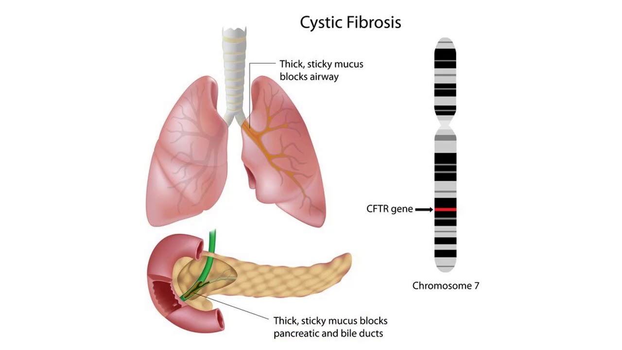 Kistik Fibrozis