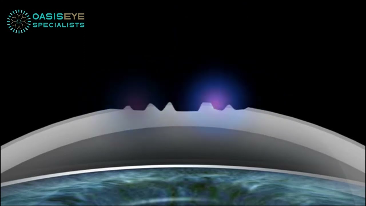 TransPRK - The Bladeless, Flapless LASIK