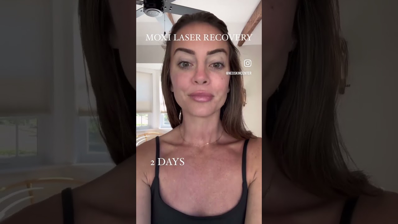 MOXI LASER RECOVERY PROCESS- skin care treatment, skin rejuvenation, facial laser