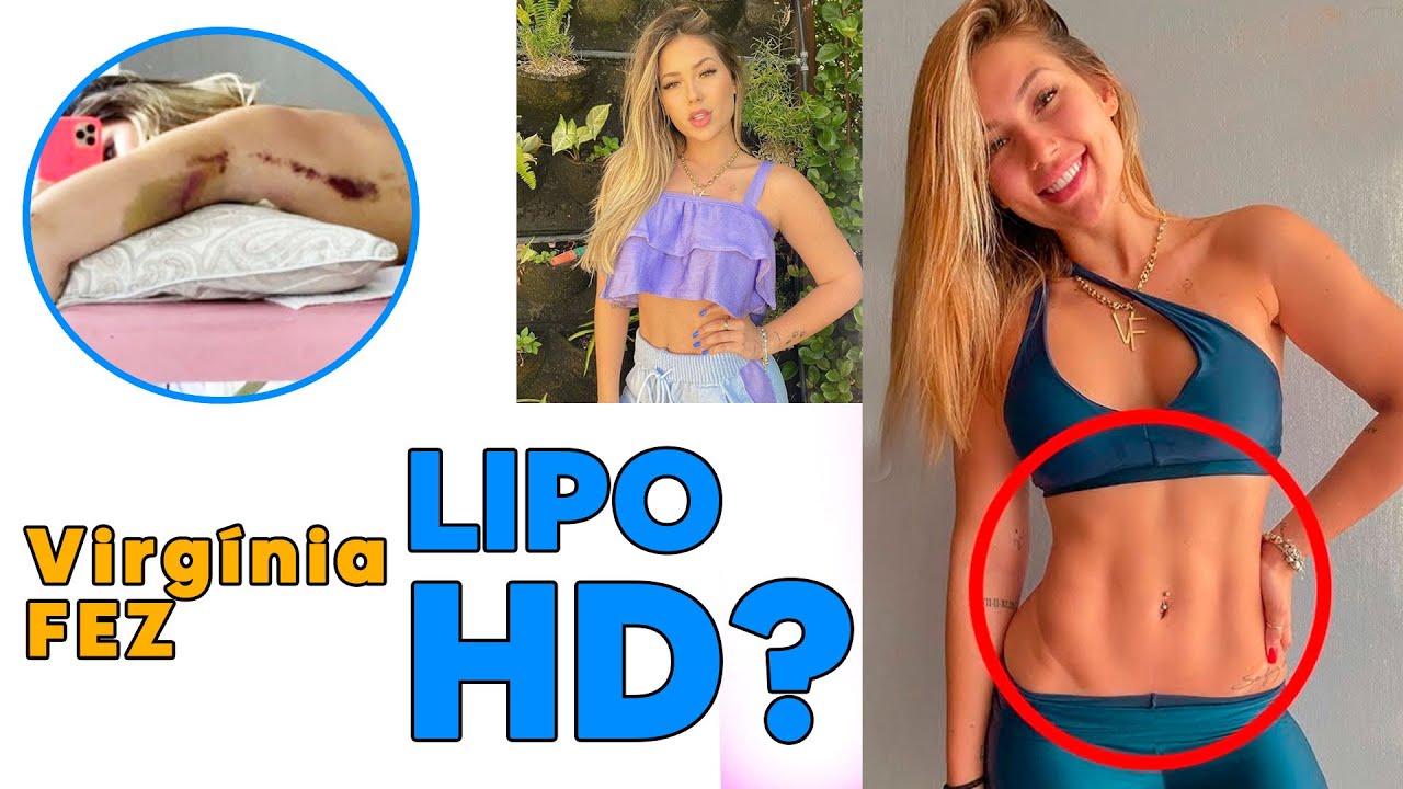 LIPO LAD VIRGINIA