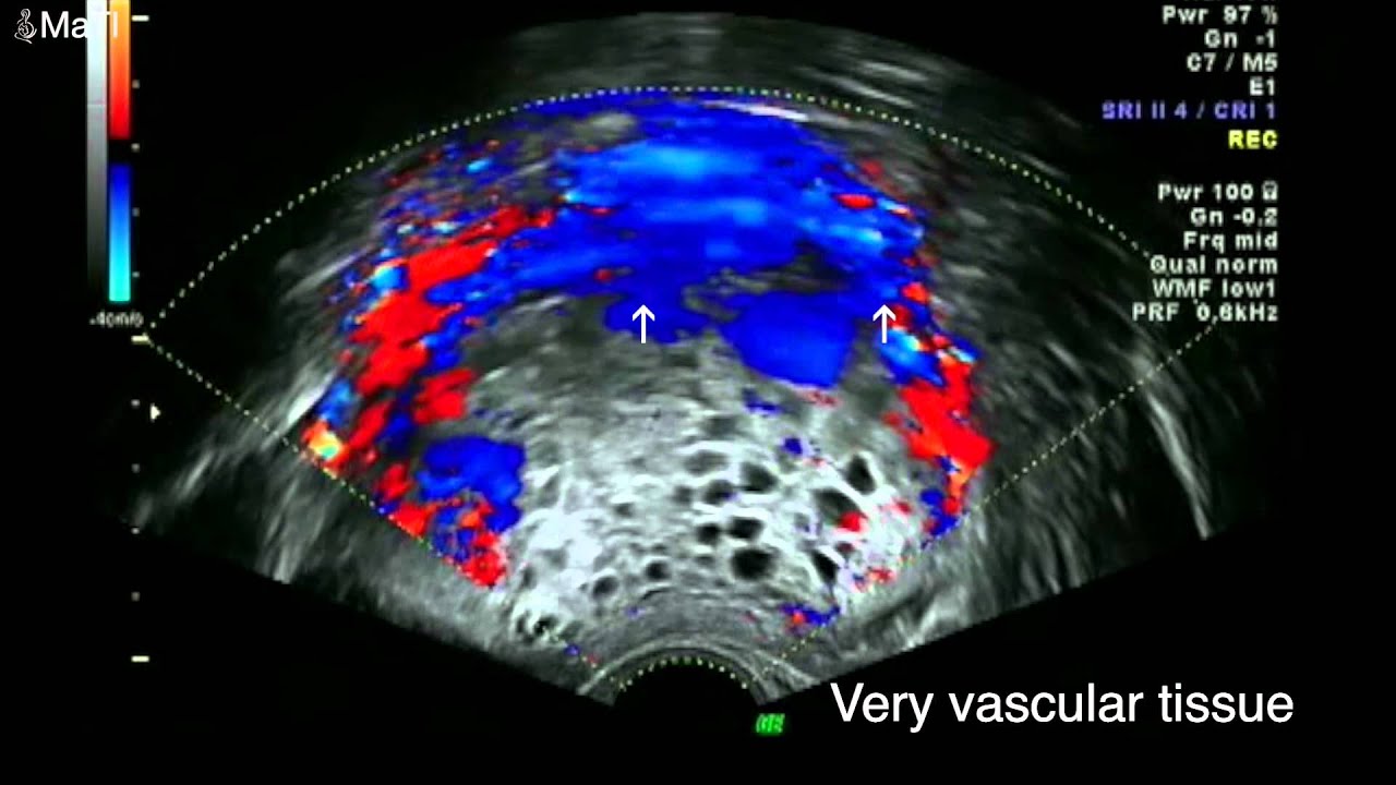 Early Pregnancy Scan - Molar pregnancy ultrasound