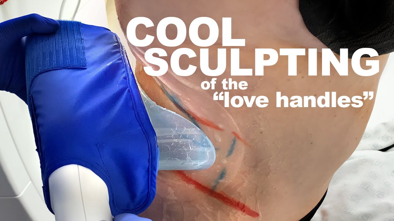 CoolSculpting of the Flanks | West End Plastic Surgery