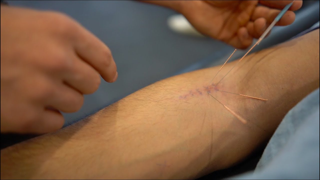 COMING BACK STRONGER : Dry needling et fine tuning