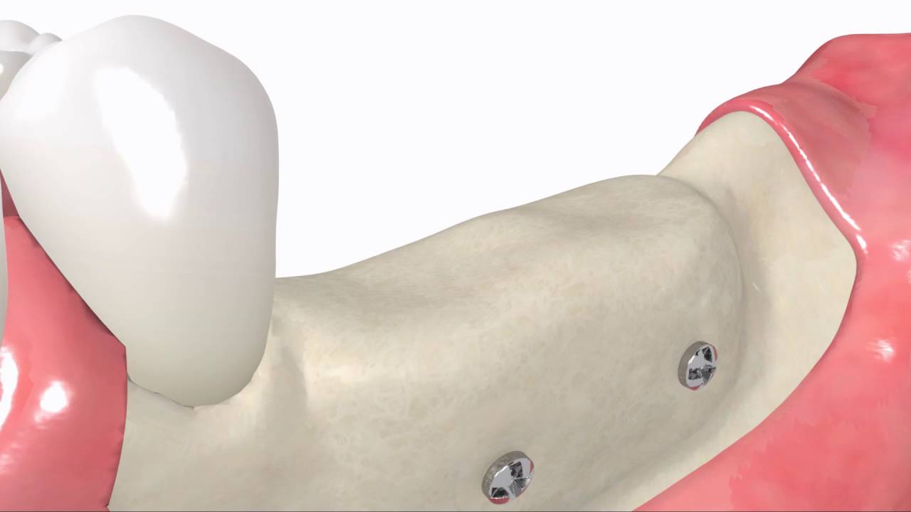 maxgraft&reg; bonebuilder technology