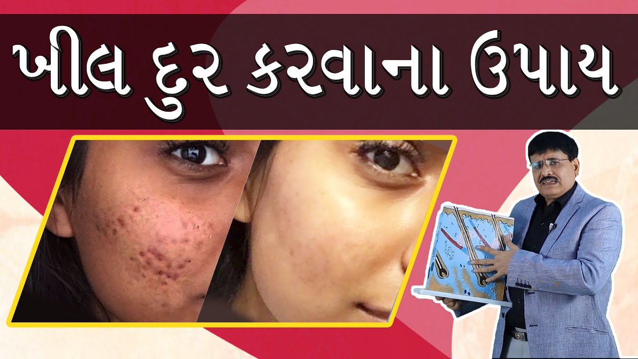 Pimples, What are Pimples, Solution for Pimples / ખીલ શું છે ? , ખીલ દુર કરવાના ઉપાય  |  in Gujarati