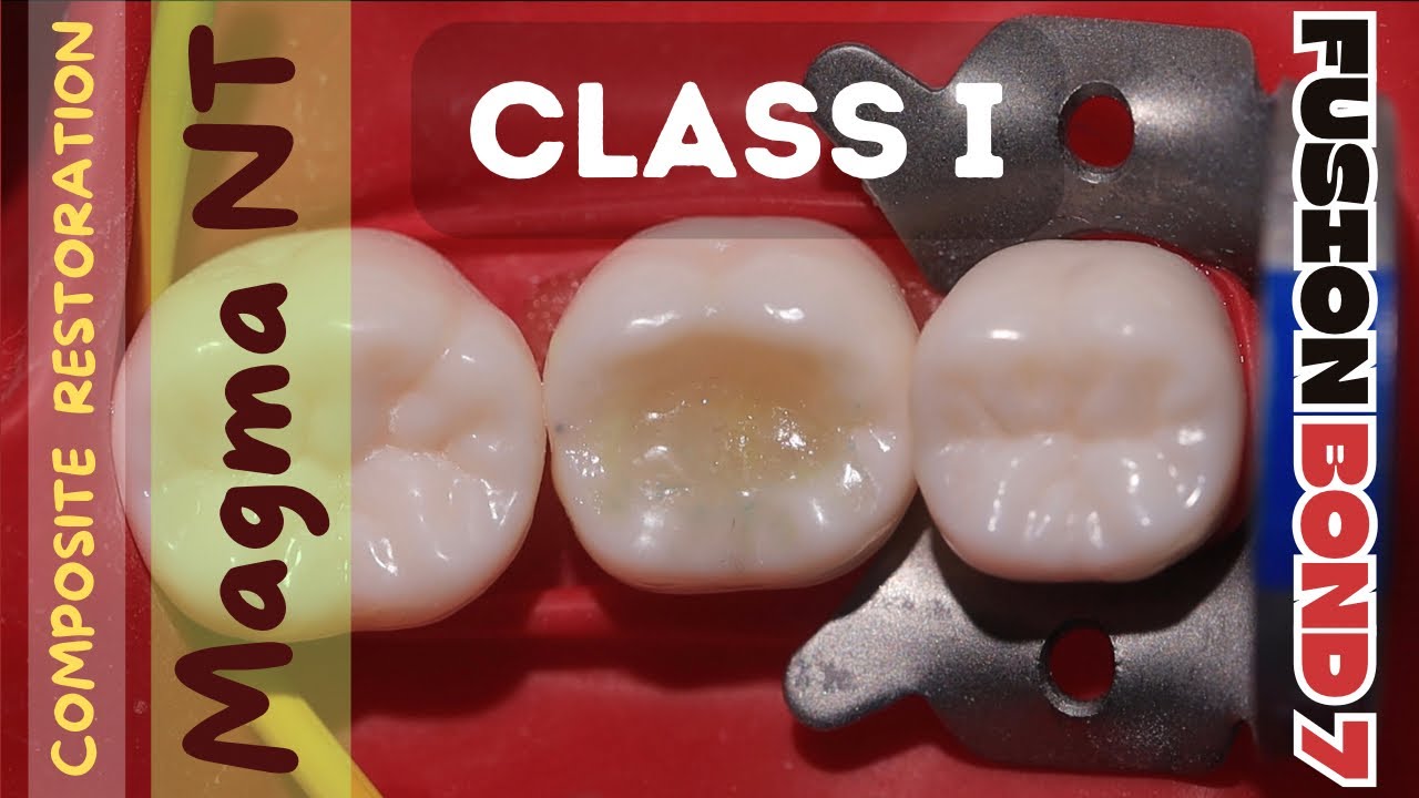 Composite Restoration 🔴 Class 1 ⚪️ Magma NT 🔵 Fusion Bond 7