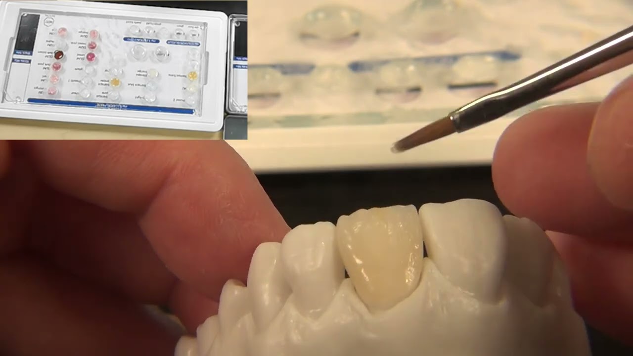 myILLUSION - Individualisierung einer Frontzahnkrone | characterisation of a anterior crown