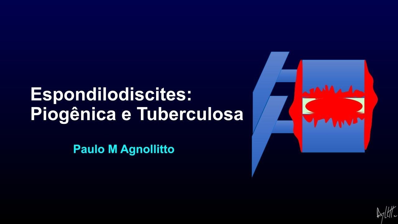 Espondilodiscites: como diagnosticar?!