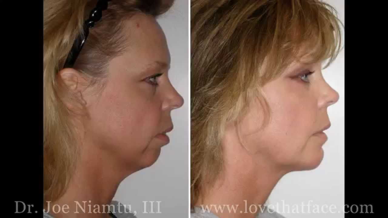 Genioplasty Versus Chin Implant