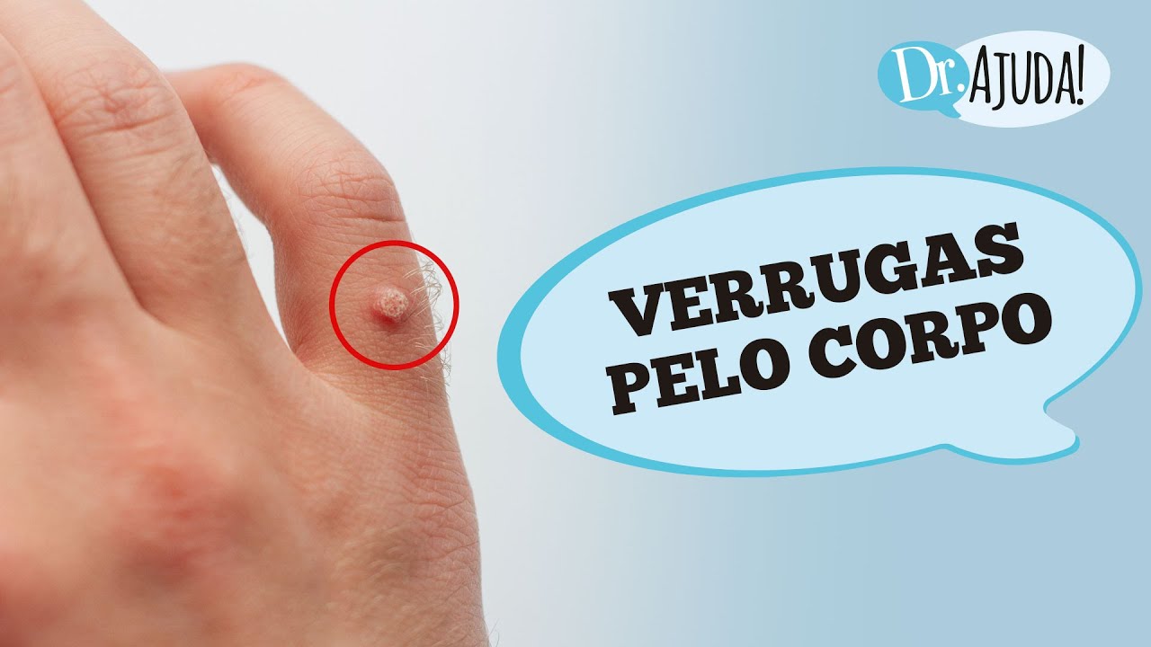 VERRUGA: TIPOS, TRANSMISSÃO, TRATAMENTO E PREVENÇÃO