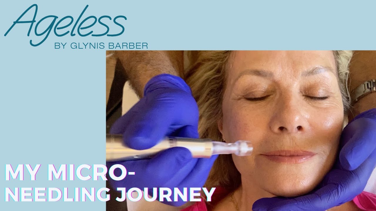 My microneedling journey