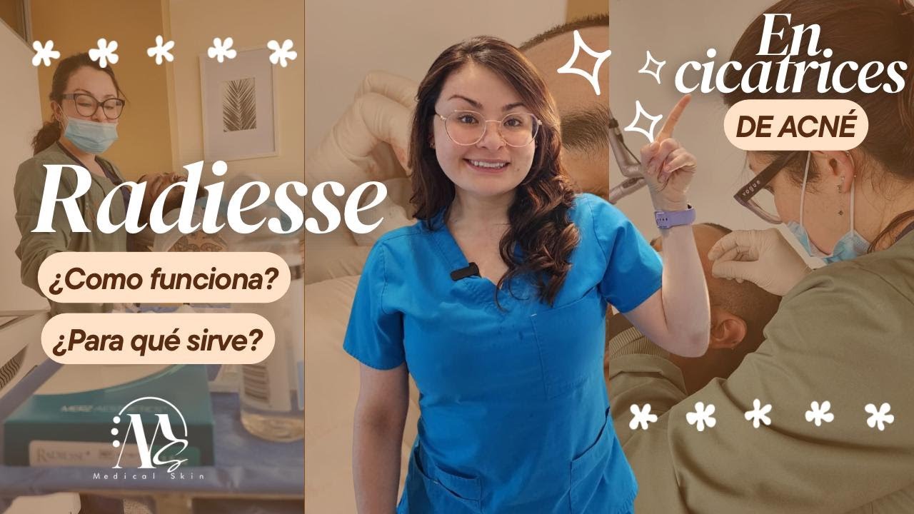 &iquest;Radiesse Funciona para las Cicatrices de Acn&eacute;? Mira el Procedimiento