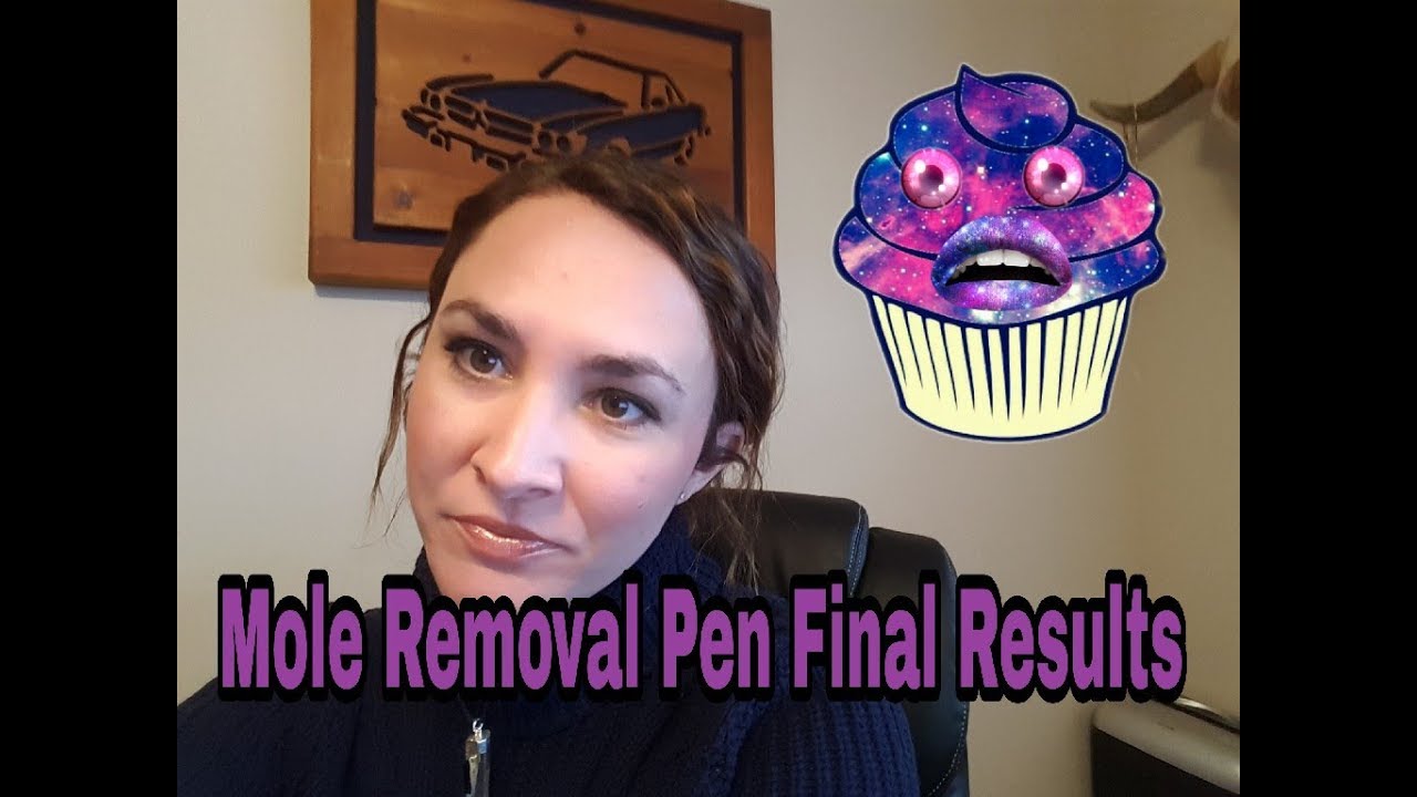 My Mole grew back!! RESULTS of the Skin Spot/Mole Tattoo Removal Pen! 1 month later
