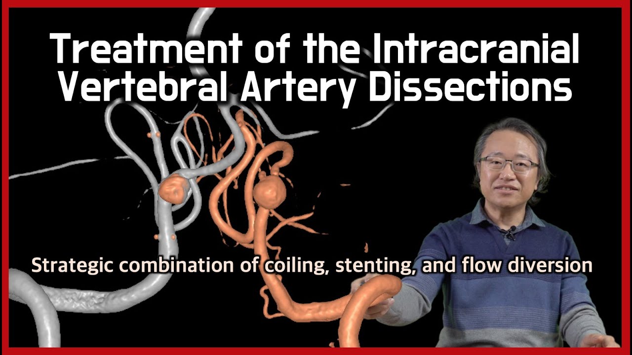 [English] Treatment of intracranial vertebral artery dissections (both ruptured and non-ruptured)