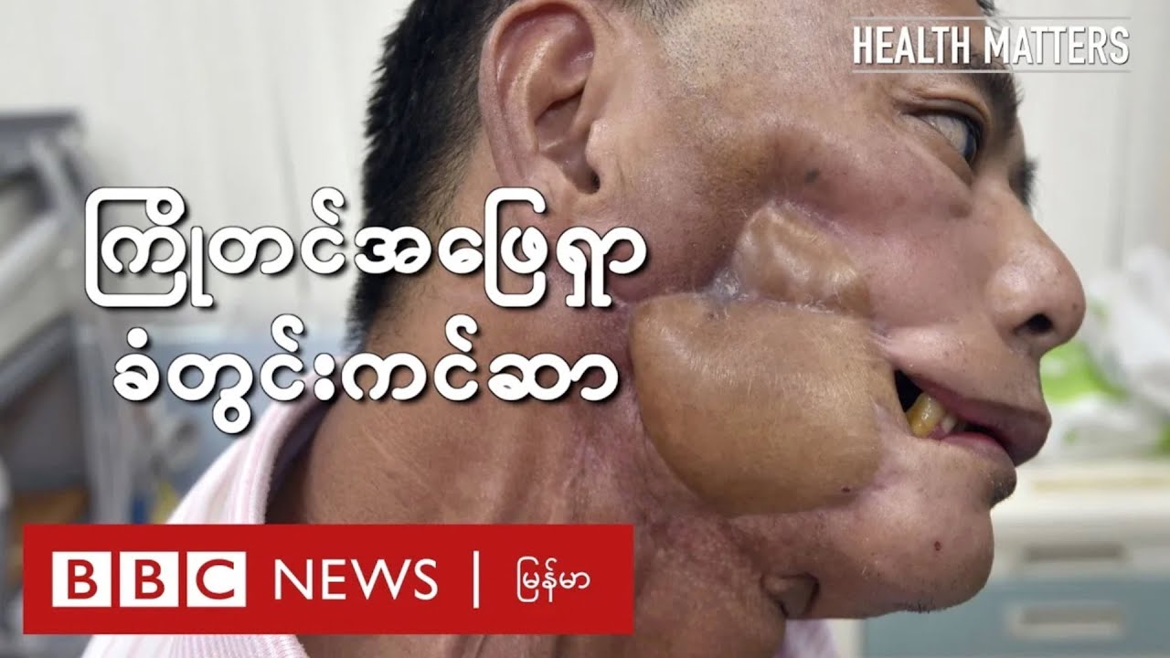 လက္ခဏာတွေ့တာနဲ့ ကုသင့်တဲ့ ခံတွင်းကင်ဆာ - BBC News မြန်မာ