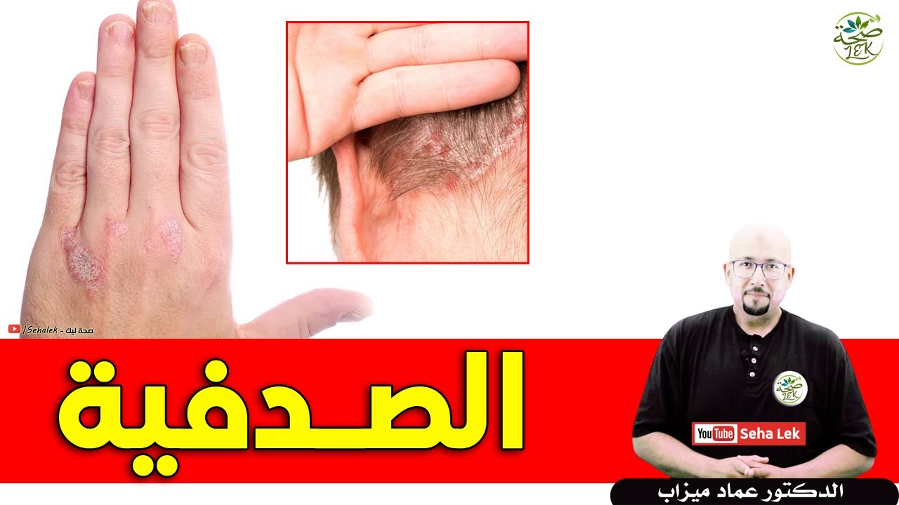 الصـدفية / د . عماد ميزاب Docteur imad mizab