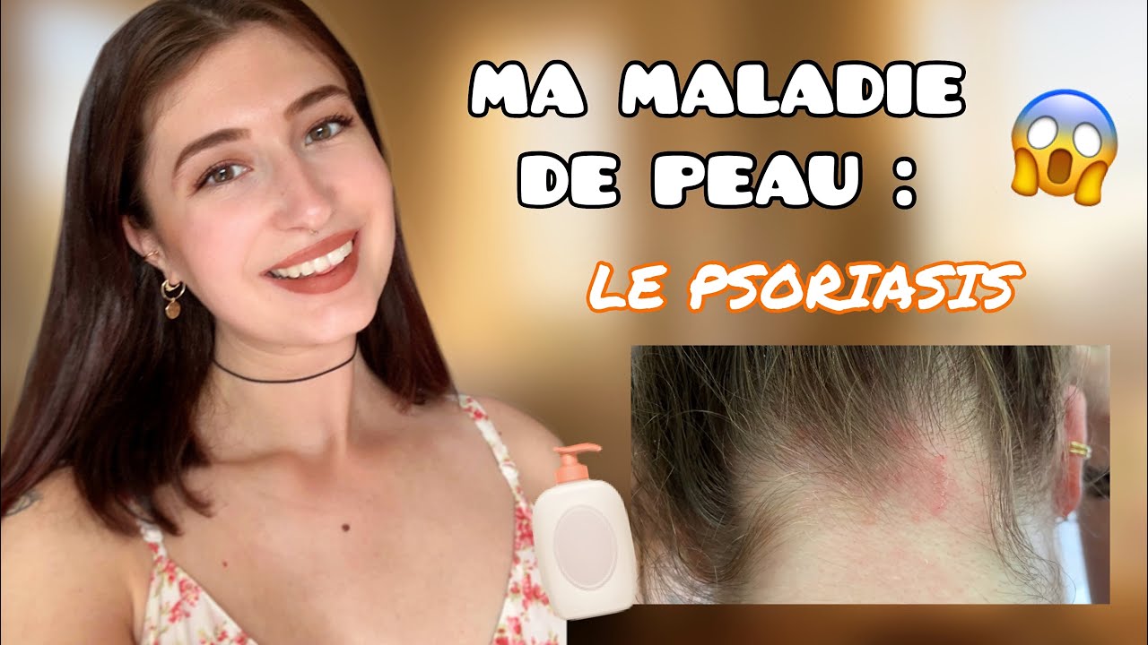 PSORIASIS : comment je m’en suis sortie ? 😔