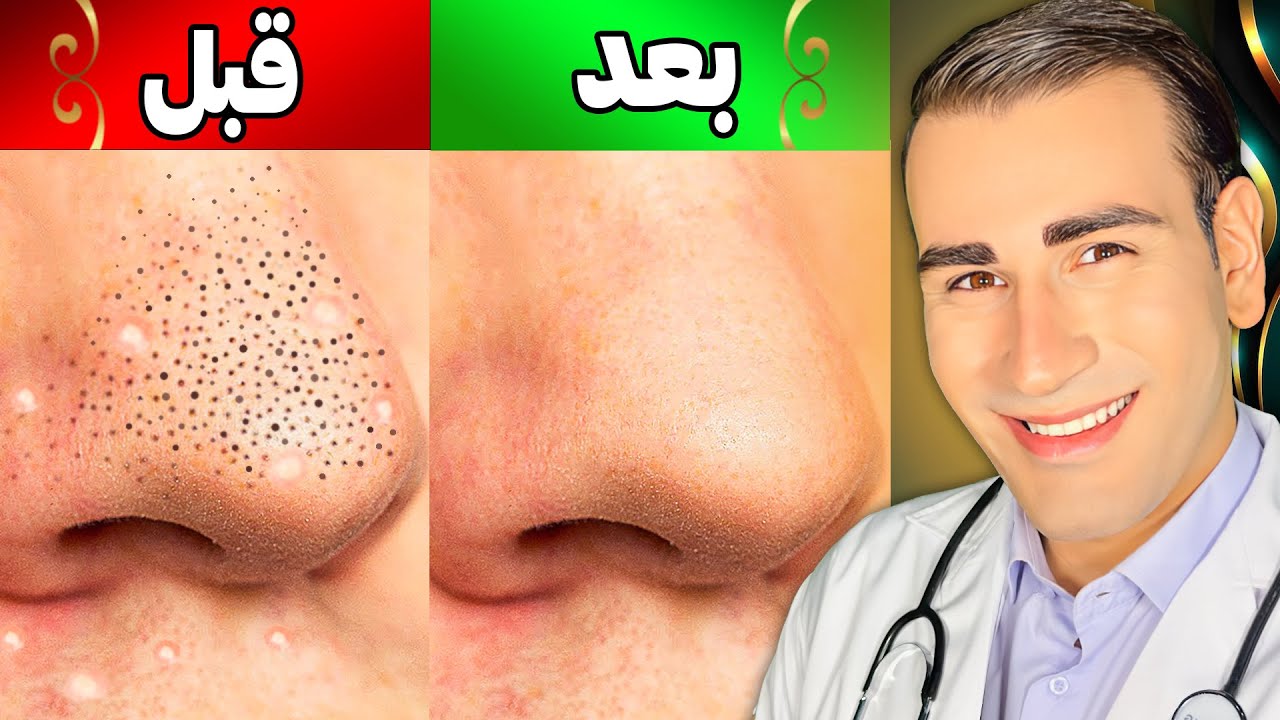از دست جوش های سرسیاه و سرسفید برای همیشه خلاص شو در خانه | Remove Blackheads and Whiteheads Forever