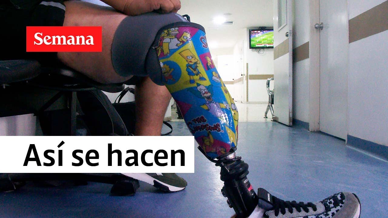 ¿Cómo se hace una prótesis para amputados? ¿Cuáles son los diseños más locos? | Semana Noticias