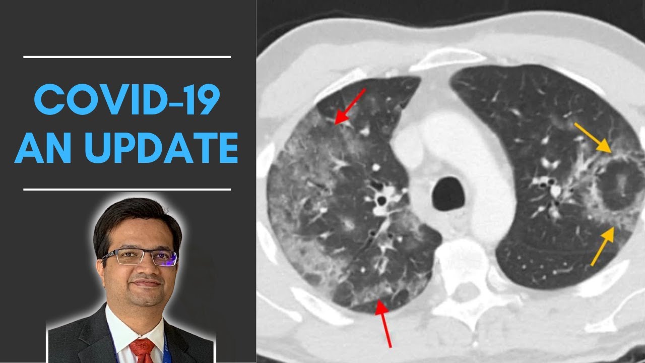 COVID-19: What the Radiologist Should Know in Current Times? | Dr. Parang Sanghavi