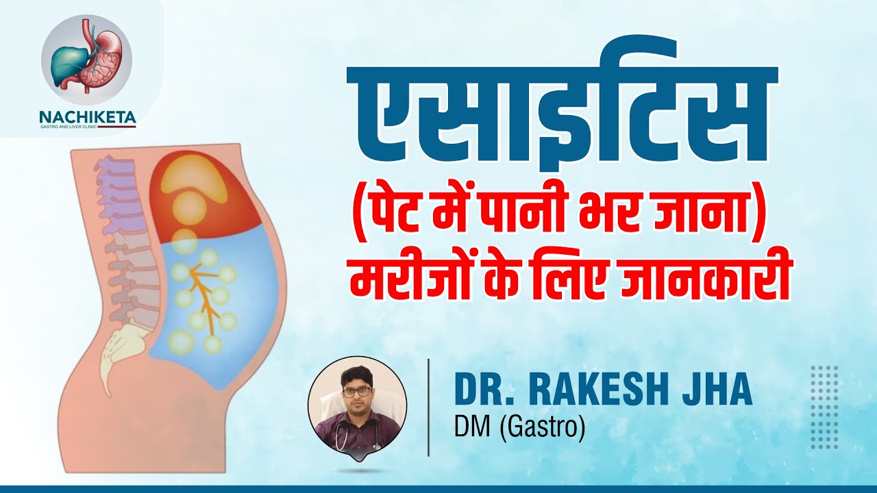 एसाइटिस (पेट में पानी भर जाना) मरीजों के लिए जानकारी - Best Gastroenterologist in Patna