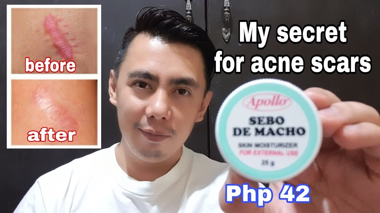5 TIPS TO REMOVE ACNE SCAR O PEKLAT WITH SEBO DE MACHO OR MUTTON TALLOW SKIN MOISTURIZER | REAL TALK
