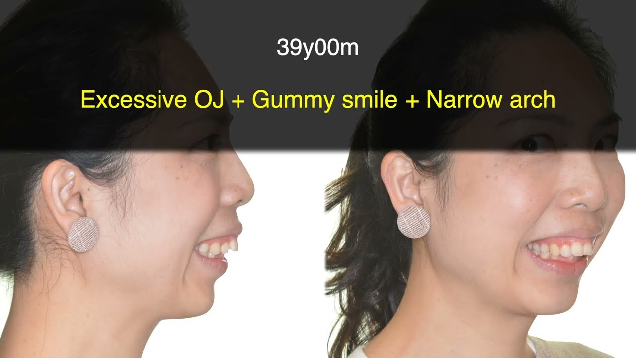 Excessive Overjet and Gummy Smile Treated with Clear Aligners｜【Chris Chang Ortho】CC671