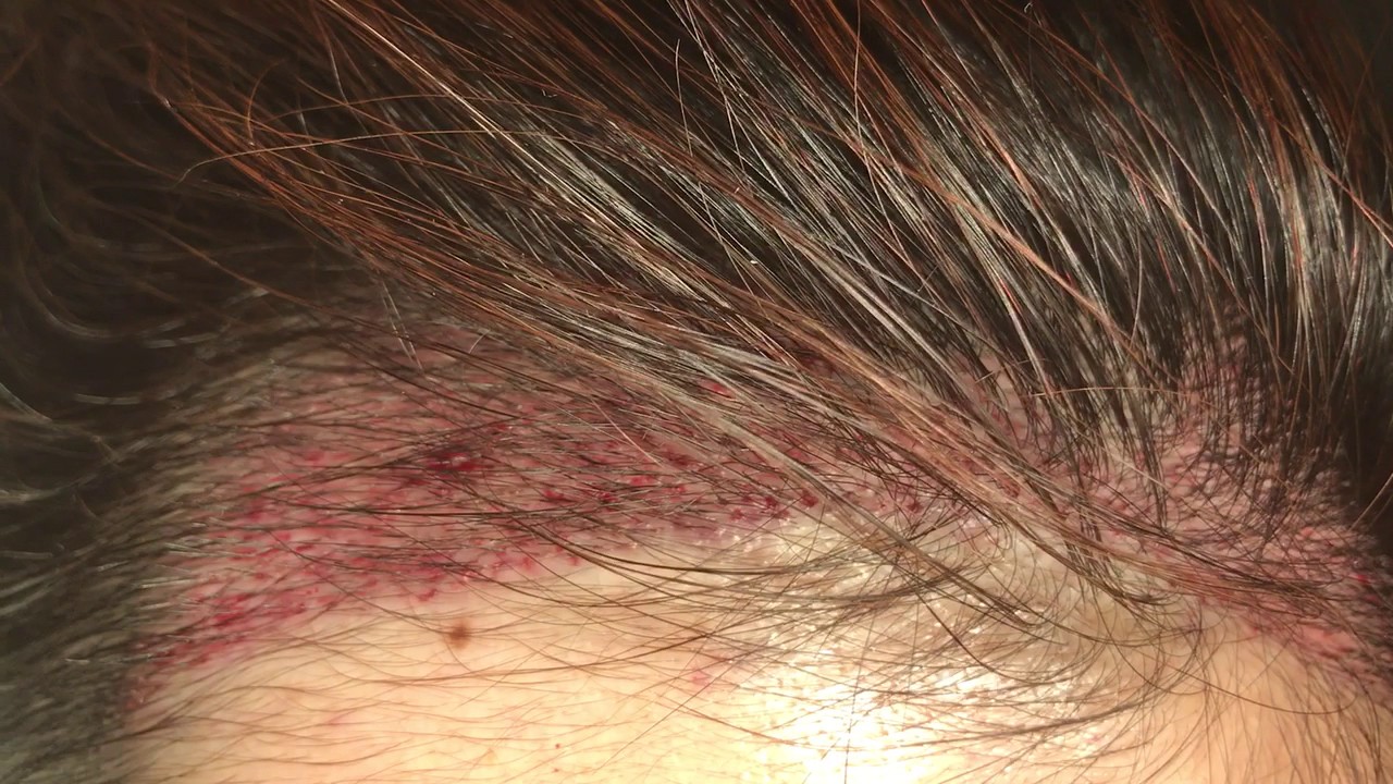 Asian Eyebrow, Hairline, Central Density, and Upper Crown Hair Transplant Recipient Site Design